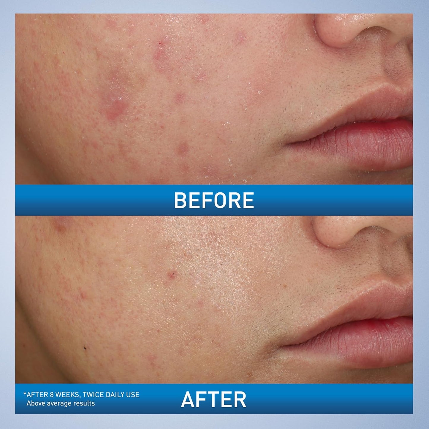 CeraVe Acne Foaming Cream Wash 10%
